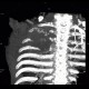 Pancoust tumor, extension into spine, lung cancer, pulmonary carcinoma: CT - Computed tomography